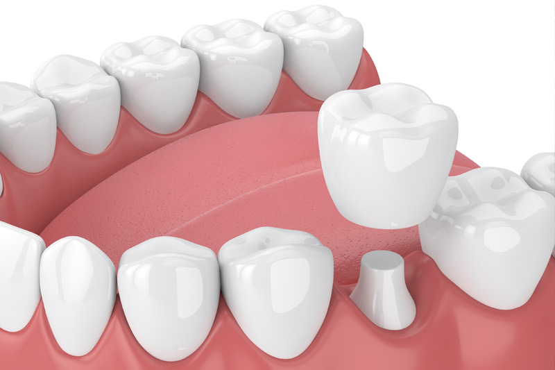 Dental Crowns in Crowley