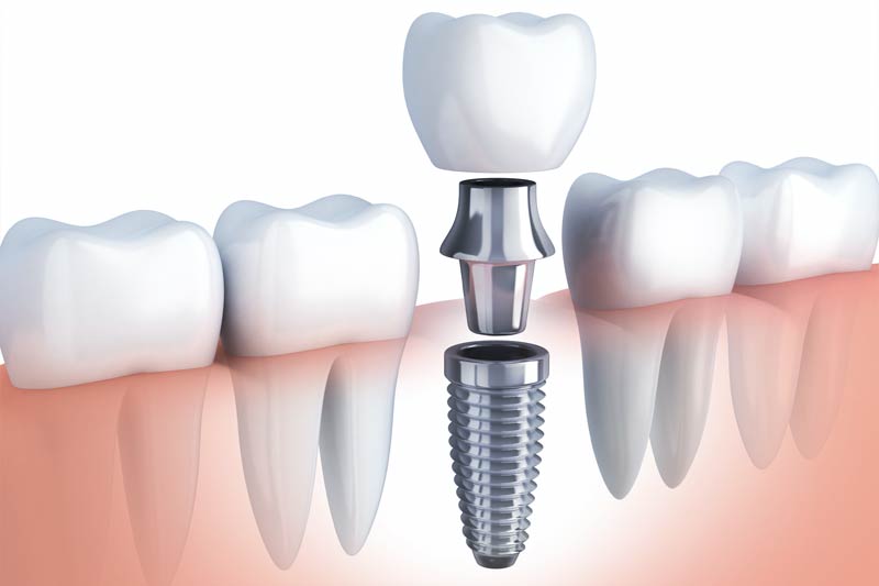Implants Dentist in Crowley