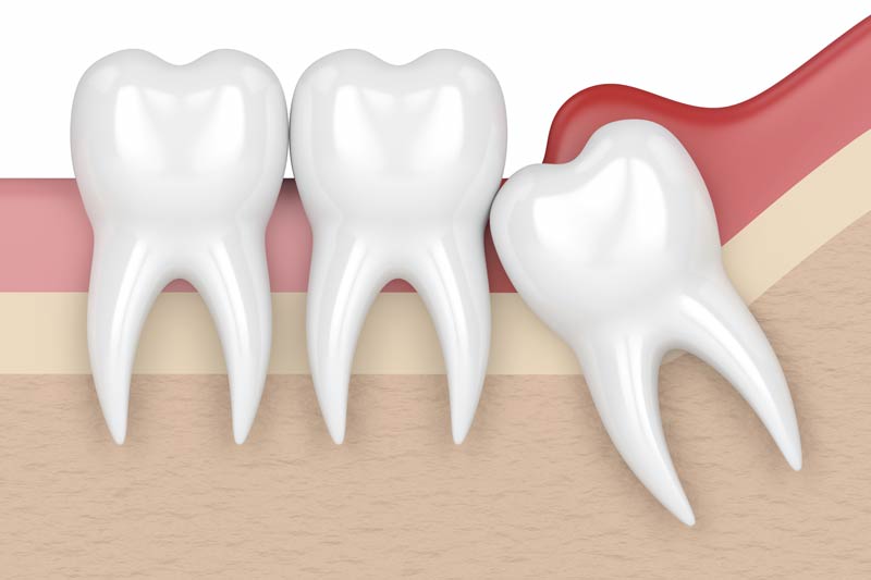 Wisdom Tooth Removal in Crowley
